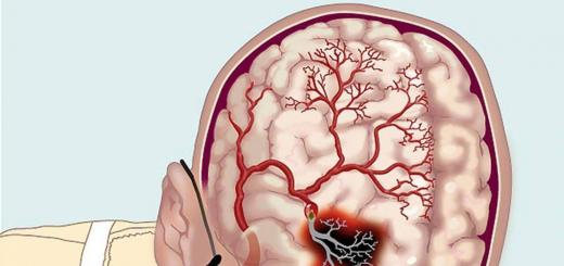 Akutni cerebrovaskularni insult možganov je glavni vzrok možganske kapi