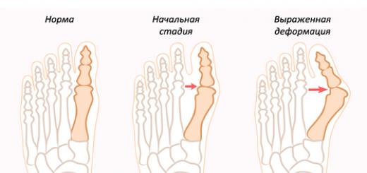 Традиционное и народное лечение растущей шишки на ноге возле большого пальца